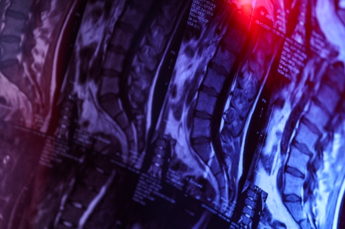 Multiple Sclerosis Coverage Delays